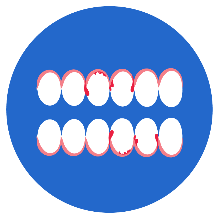 Bleeding Gums 
